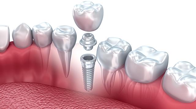 How to choose a dental implant?