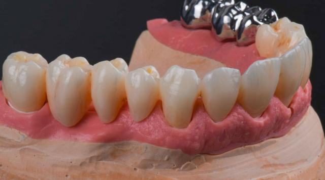 What is the cost of installing all jaw teeth in Croatia?