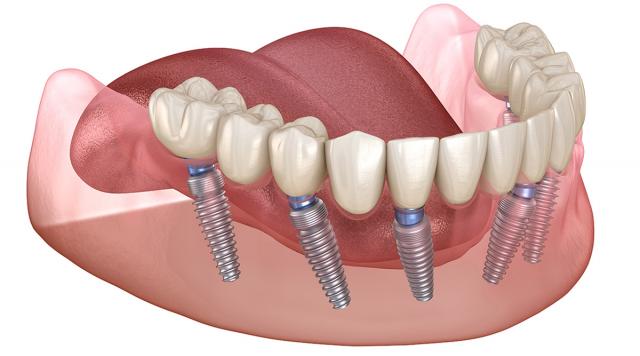 All-on-6 procedure in Croatia