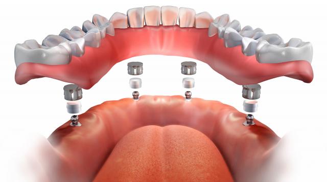 Why patients prefer the All-on-4 method?