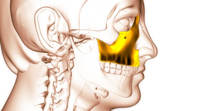 Zygomatic Implants